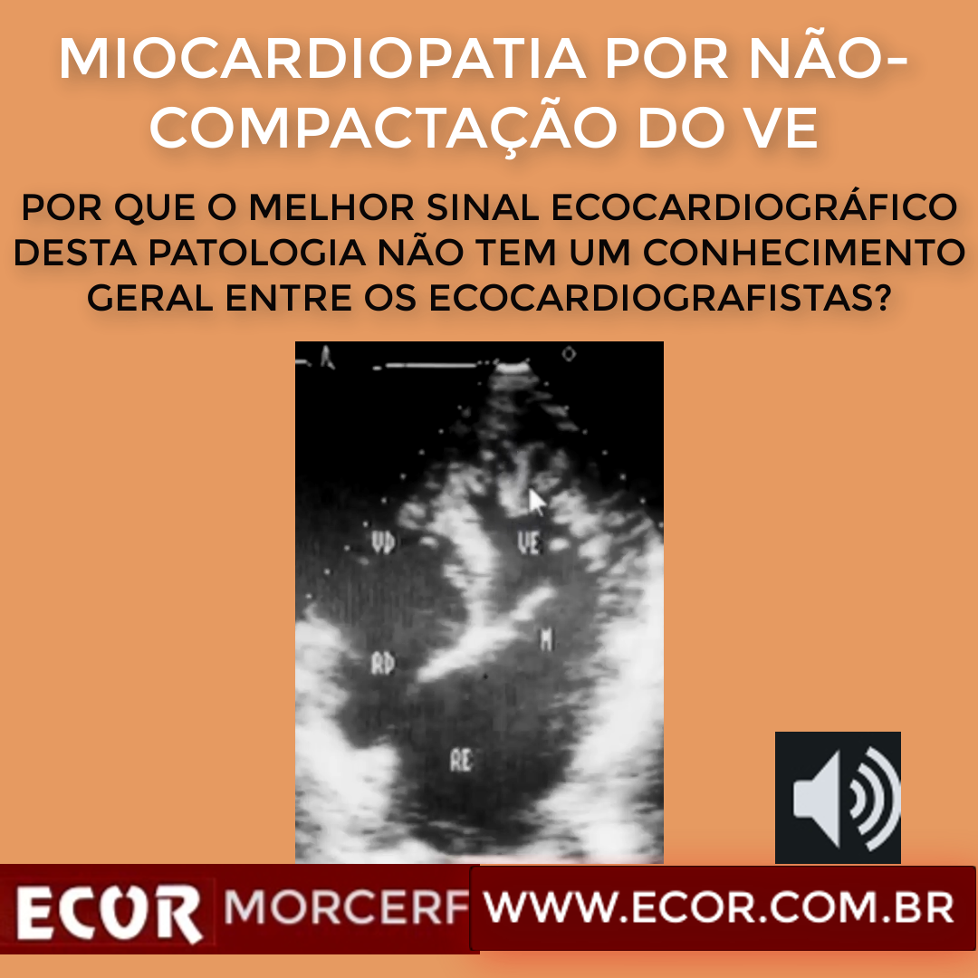 Miocardiopatia