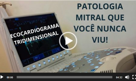 MITRAL EM ARCADA